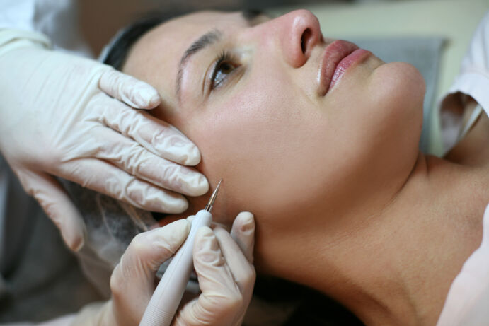 mole removal treatment 
